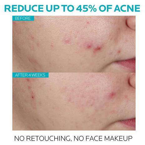 EFFACLAR SALICYLIC ACID ACNE TREATMENT SERUM